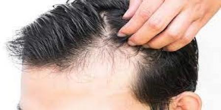 راهکارهای پیشگیری و یا بهبود بیماری ریزش مو از منظر طب ایرانی 1 راهکارهای پیشگیری و یا بهبود بیماری ریزش مو از منظر طب ایرانی