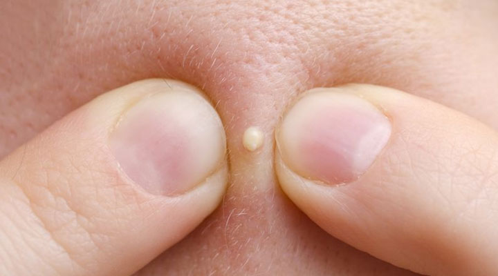 ۱۲ نادرست رایج در روتین پوستی که همین امروز باید ترک کنید 6 ترکاندن جوش از اشتباهات رایج روتین پوستی