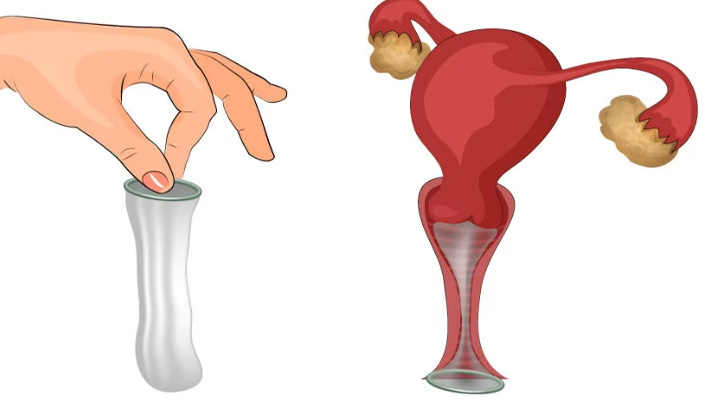 کاندوم زنانه؛ انواع، مزایا، معایب و روش استفاده_سودو تکنولوژی 7 نحوه استفاده از کاندوم زنانه