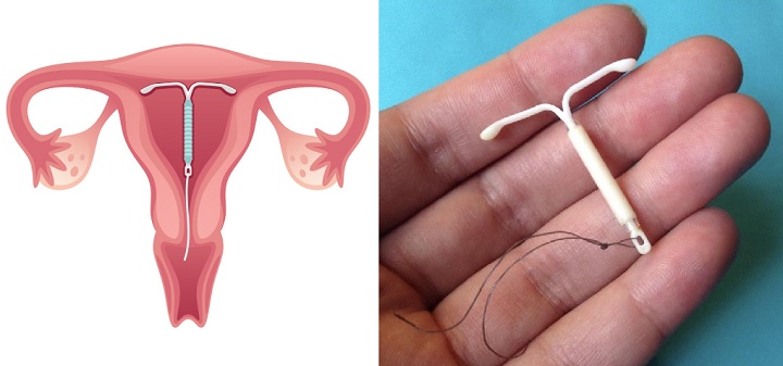متروراژی و منومتروراژی؛ خونریزی غیرطبیعی سپس از پریود_سودو تکنولوژی 2 آی یو دی از روشهای پیشگیری از بارداری که می تواند موجب متروراژی شود