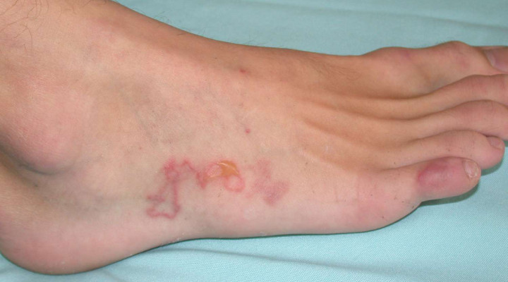 عفونت انگلی واژن؛ هر آنچه باید بدانید_سودو تکنولوژی 2 عفونت انگلی - عفونت انگلی - علائم عفونت انگلی