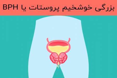 آگهی/ با بیماری پروستات یا بزرگی خوشخیم پروستات آشنا شوید_سودو تکنولوژی 1 آگهی/ با بیماری پروستات یا بزرگی خوشخیم پروستات آشنا شوید