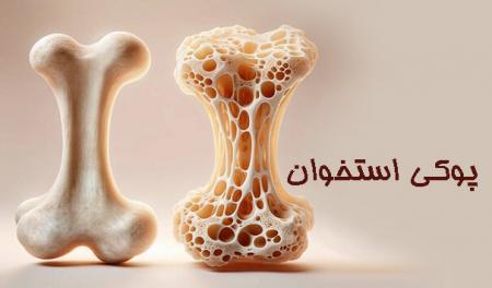 با بیماری شایع میانسالی بیشتر آشنا شوید
