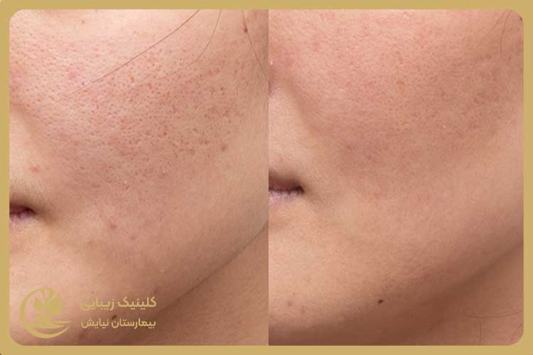 آگهی/ کلینیک زیبایی عرفان نیایش: بهترین مرکز آر اف فرکشنال غرب_سودو تکنولوژی 4 چرا باید کلینیک زیبایی عرفان نیایش را انتخاب کنید؟