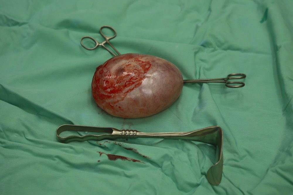 خارج کردن موفقیت‌آمیز توده بزرگ شکمی در بیمارستان کودکان حکیم + عکس